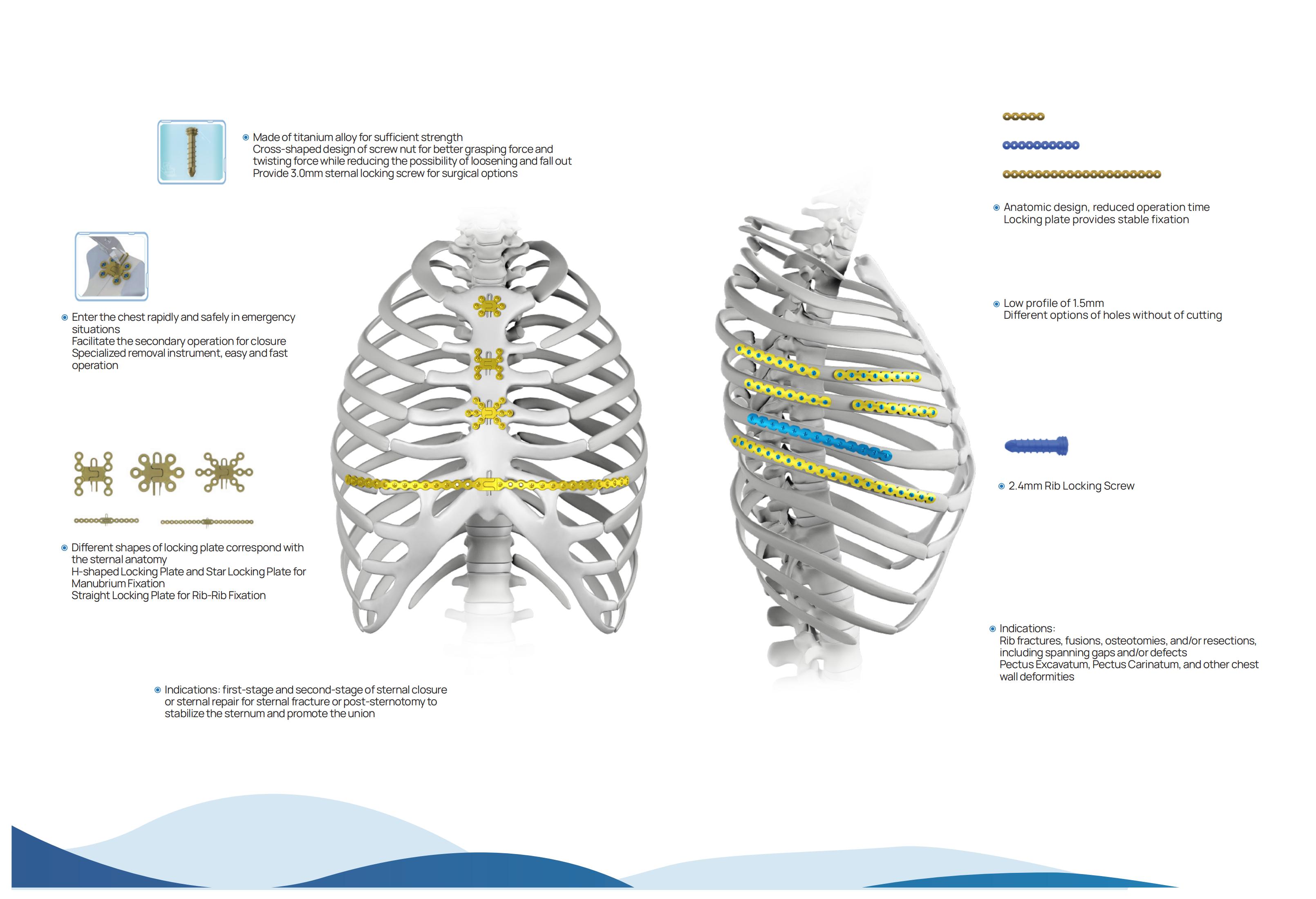 Rib Fixation System