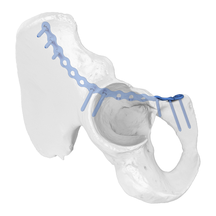 Flexibles Acetabulumplattensystem (FAP) Iliopubic Anterior Column Anatomic Locking Plate
