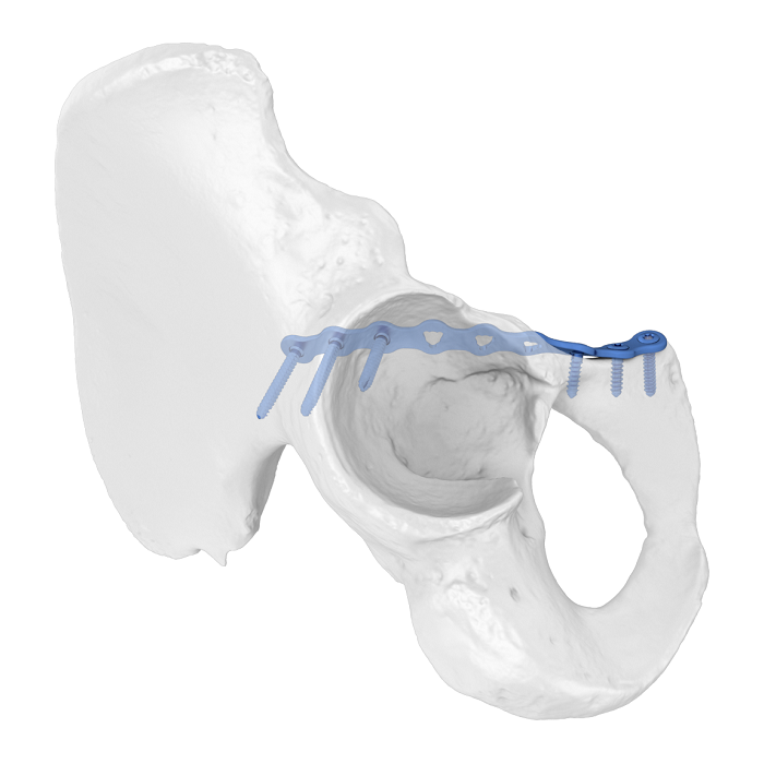 Flexibles Acetabulumplattensystem (FAP) Iliopubic Anterior Line Anatomische Verriegelungsplatte
