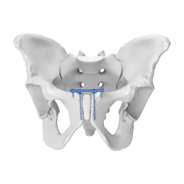 Flexible Acetabulumplatte (FAP) System Symphysis Schambein Obere anatomische Verriegelungsplatte
