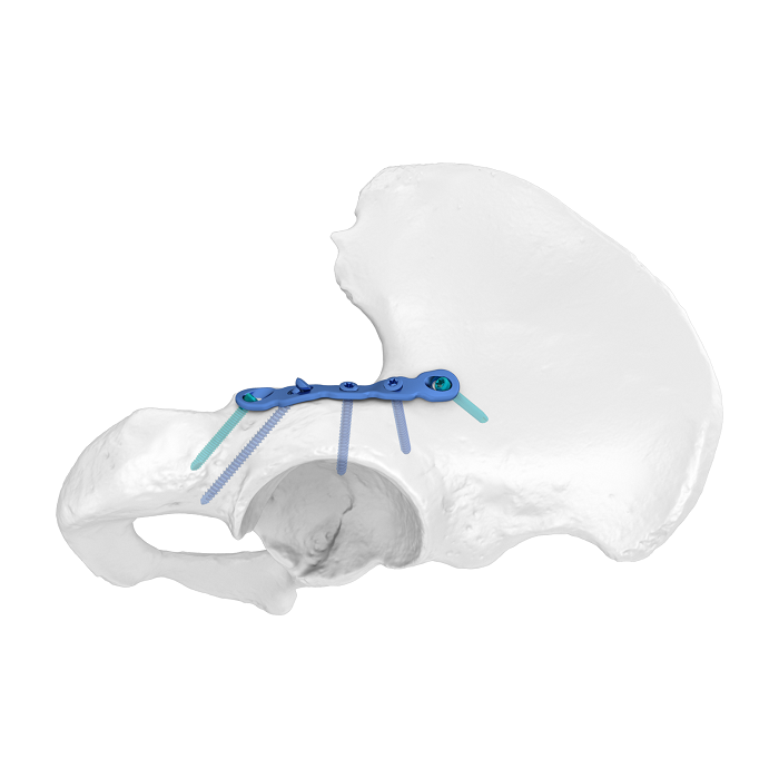 Flexibles Acetabulumplattensystem (FAP) Anatomische Verriegelungsplatte für die hintere Säule
