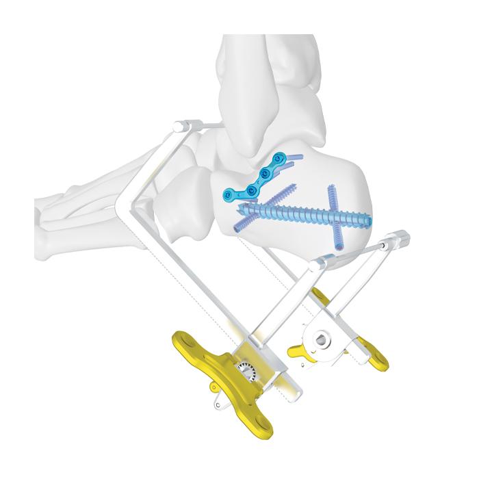 Calcaneale Kanülierte Schraube