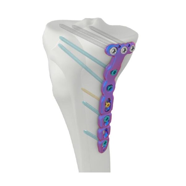 VAL proximale mediale Tibia-Verriegelungsplatte