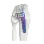 VAL proximale laterale Tibia-DR-Verriegelungsplatte