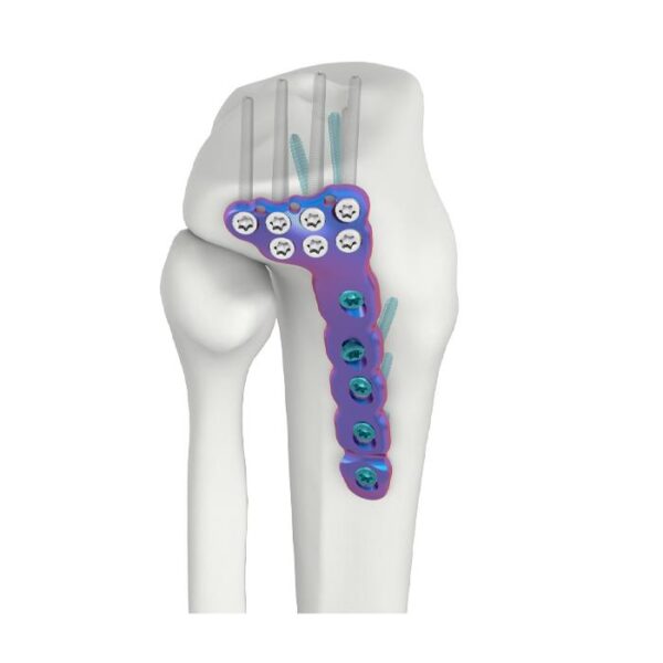 VAL proximale laterale Tibia-DR-Verriegelungsplatte