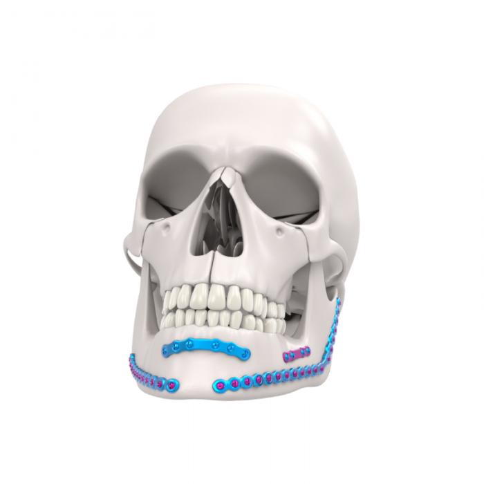 Mandibelfixierungssystem