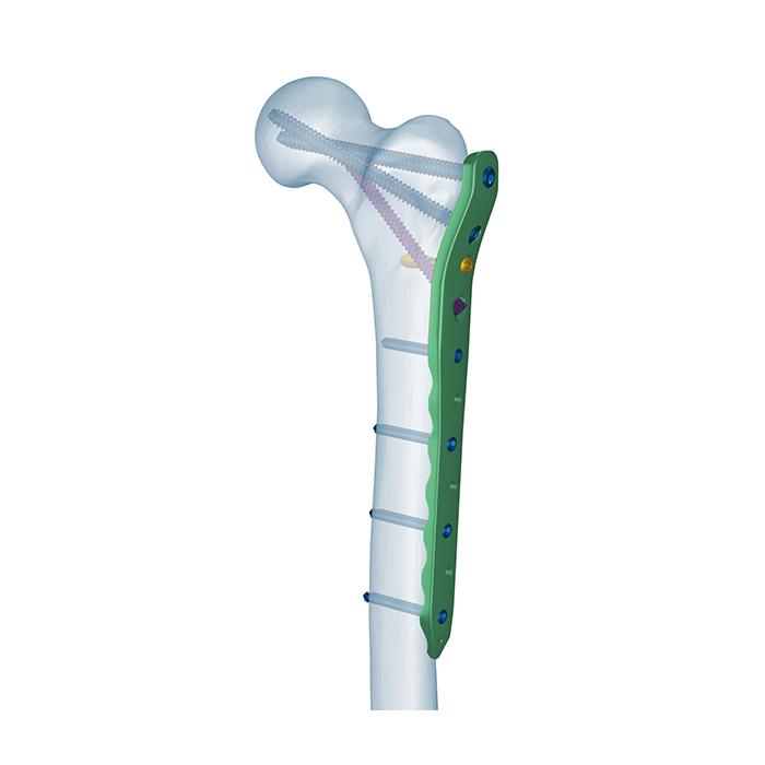 Proximale Femurverriegelungsplatte