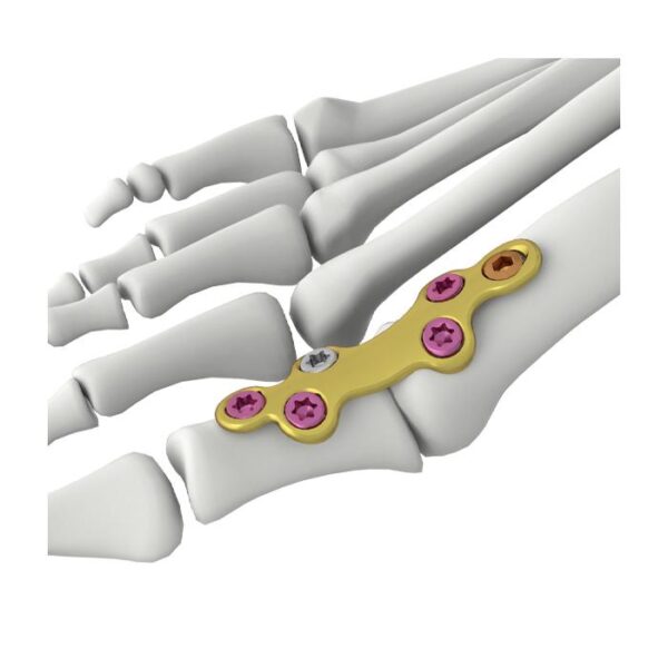 Itval MTP-Fusionsverriegelungsplatte