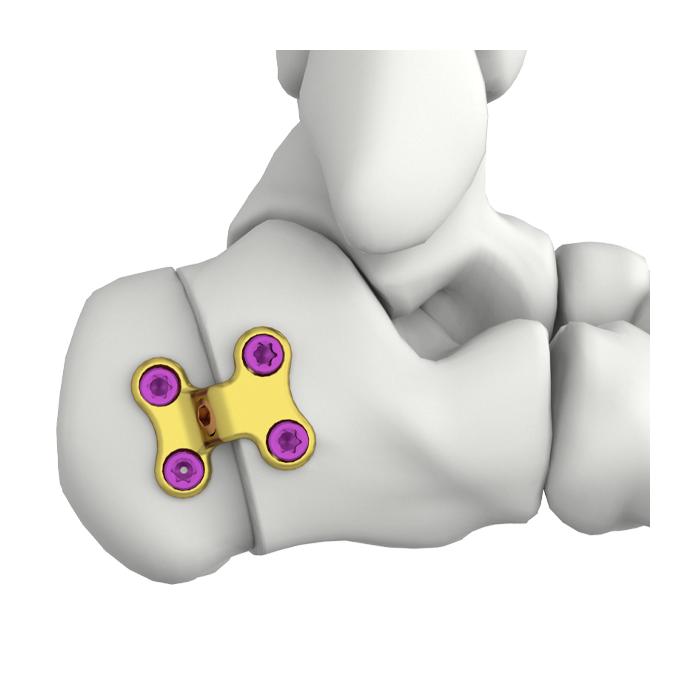 Itval Calcaneus-Stepped-Verriegelungsplatte