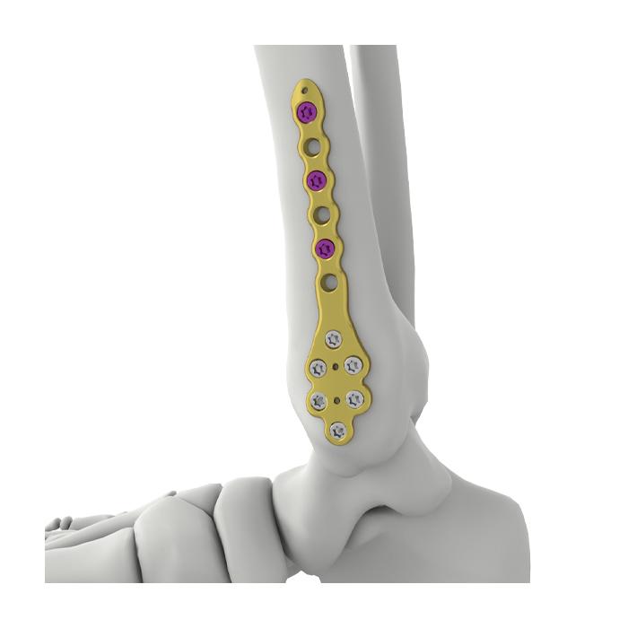 Itval distal mediale Tibia-Verriegelungsplatte