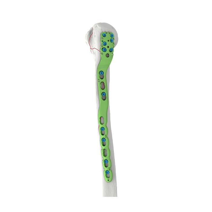 Proximale humerale gedrehte Verriegelungsplatte