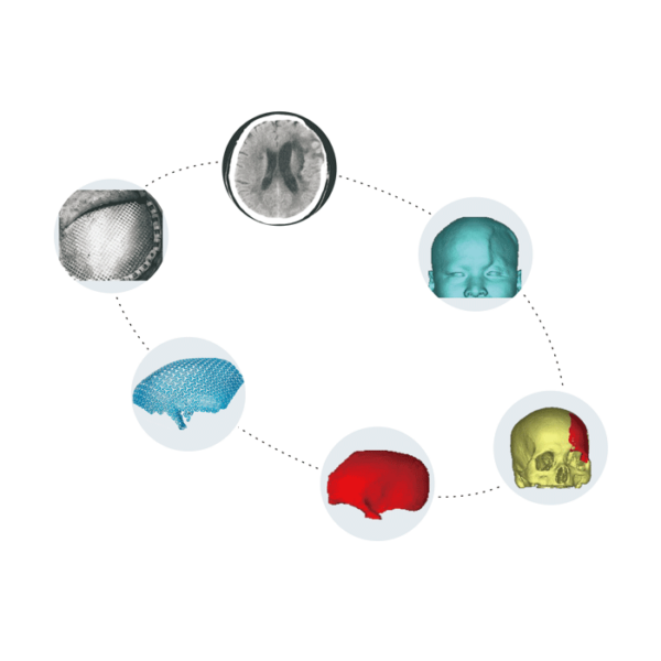 Patientenspezifisches Implantat – PSI