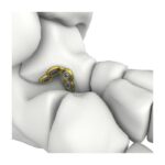Itval Talus Verriegelungsplatte
