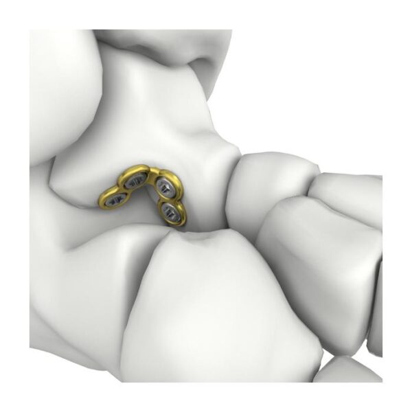 Itval Talus Verriegelungsplatte