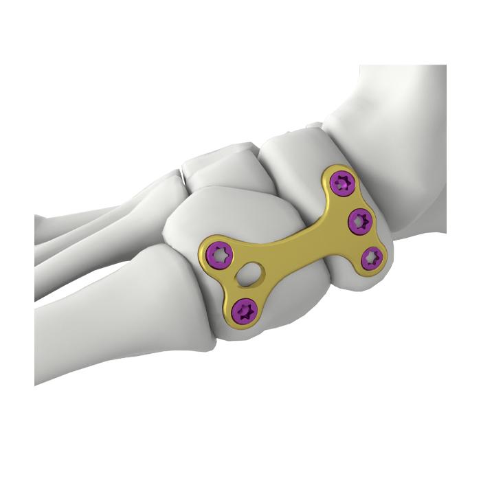 Itval Navicular Cuniform-Fusionsverriegelungsplatte