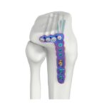 VAL proximale laterale Tibia-SR-Verriegelungsplatte mit geringer Biegung