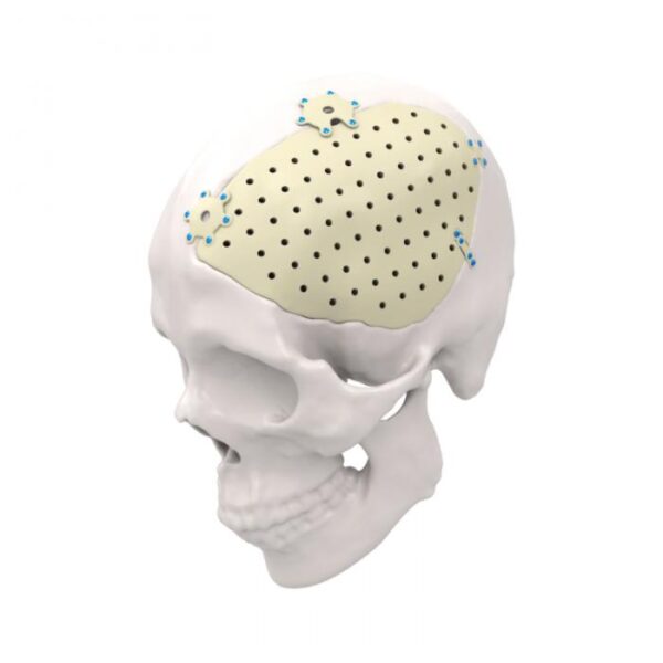 Personalisiertes PEEK- und Titan-Patienten-spezifisches Implantat für die Schädelreparatur und -rekonstruktion