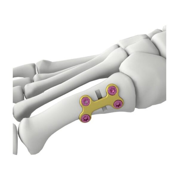 Itval Erste Mittelfuß-Osteotomie-Verriegelungsplatte